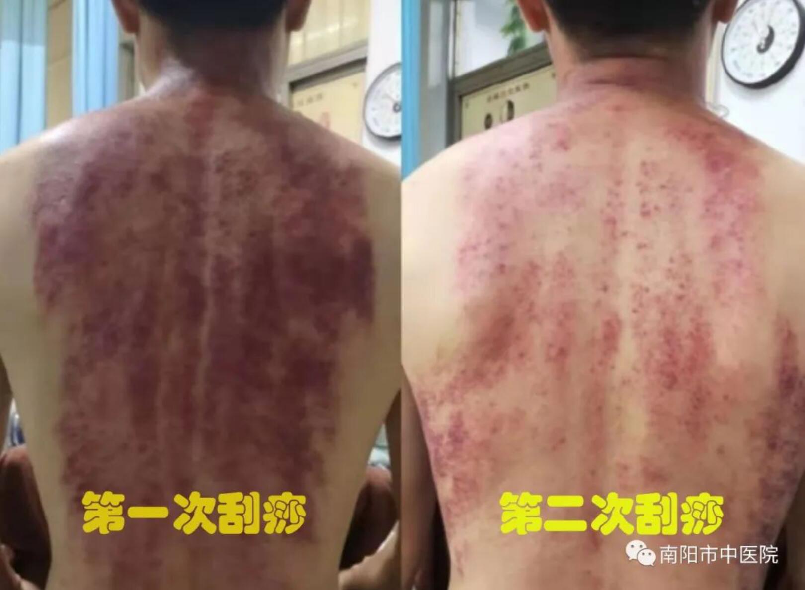 7背部刮痧.jpg