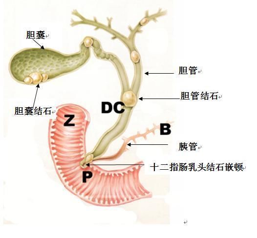 1胆囊结石图.jpg