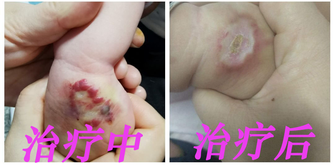 0002治疗中、后.jpg