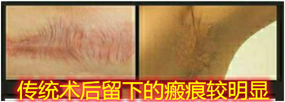 传统术后留瘢.png